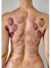 ビレイ(Birei)/カッピング