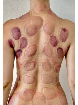 ビレイ(Birei)/カッピング