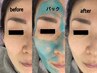 【ハリ×艶】全顔毛穴洗浄+ヒアルロン酸導入+ジェルパック+ヘッド+保湿¥7500