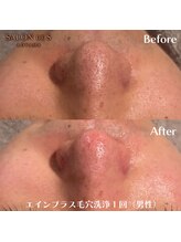 サロン ド エス アオヤマ(SALON DE S AOYAMA)/男性のしつこい毛穴汚れも１回で