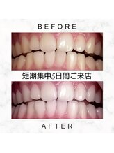 エミリアホワイトニング(EMIRIA WHITENING)/Before/After