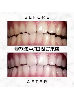 エミリアホワイトニング(EMIRIA WHITENING)/Before/After