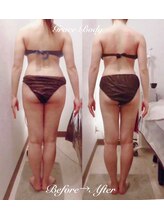 痩身脱毛専門店 グレイスボディ MEGAドンキホーテ三郷店(Gracebody)/◆痩身　症例写真