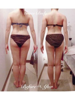 痩身脱毛専門店 グレイスボディ MEGAドンキホーテ三郷店(Gracebody)/◆痩身　症例写真