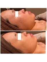 チェンジ 小山店(Change)/ローズドメーラ施術