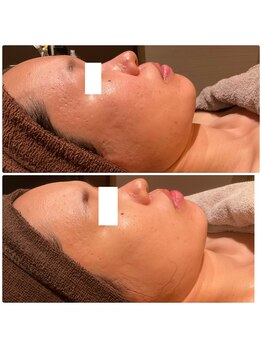 チェンジ 小山店(Change)/ローズドメーラ施術