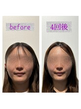 ルシアス(LUCIAS)/小顔矯正