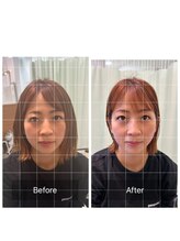 あらた鍼灸整骨院/美容鍼