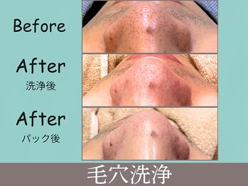 プレジール(plaisir)/毛穴洗浄