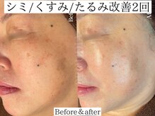 プラウディア(PROUDIA)/エイジングケア/くすみ／小顔