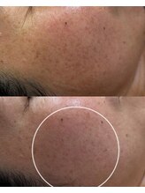 ココリール/乾燥肌・しみ