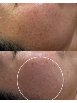 ココリール/乾燥肌・しみ