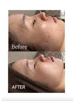 エクラ(ECLAT)/レストセルトリートメント