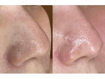 スムース イー(Smooth+E)の写真/【効果即実感】いちご鼻・黒ずみ・角栓すっきり！ざらつきなしのツルツル肌にトーンアップ◎化粧ノリ抜群！