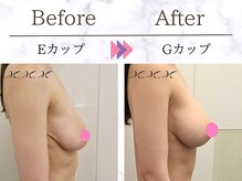 メディカルサロン エム エム エム 心斎橋本店(M.M.M)/【バストアップ例】　E→Gカップ