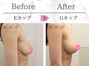 メディカルサロン エム エム エム 心斎橋本店(M.M.M)/【バストアップ例】　E→Gカップ