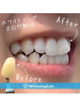 ホワイトニングカフェ 熊本店(WhiteningCafe)/◎歯のホワイトニング症例写真◎