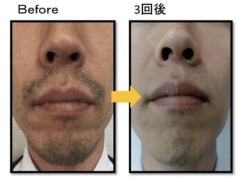 ヴィオール 名古屋栄店(VIOR)/【メンズ脱毛】　ひげ