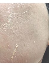 マリー エクラン/ハーブピーリング