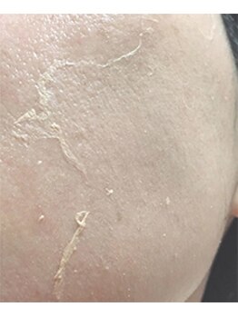 マリー エクラン/ハーブピーリング