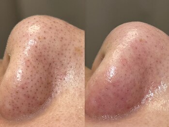 フレーズ(fraise)/毛穴エクストラクション