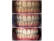 ホワイトニング ビューティー 南魚沼店(whitening beauty)の雰囲気（結果重視！口元気にせず輝く笑顔に）