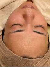 アドビューティ(Add Beauty)/≪たるみ改善／RFリフティング≫