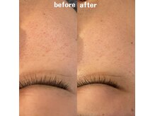 グレアージュ(GLEAGE)/水光イオン導入！