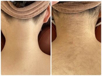 エステティック レイビス 銀座店(RAYVIS)/脱毛効果写真