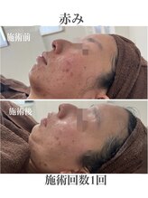 テンニック(10nick)/1回での効果が高い