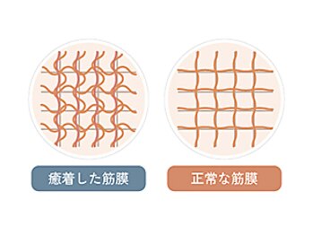痛み不調専門整体 GymNat/筋膜イメージ