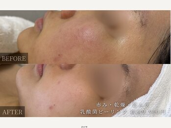 ピュア(pure)/ピーリング2回