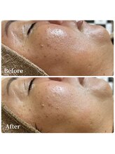 エース(ACE.)/くすみ改善☆肌のトーンアップ