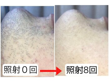 メンズスリーナインサロン(Men's ThreeNines Salon)/髭光