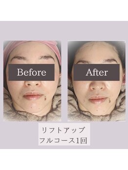 メロウ(Mello)/リフトアップ◇Before→after