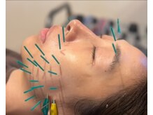 すぎ/福山で1番人気なすぎの美容鍼