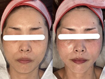 Nビューティー/最新RFサーモシェイプオーパス