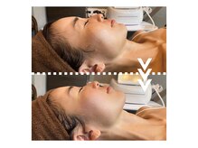 リエイト(Re:eight)/マイクロウェーブリフト1回施術