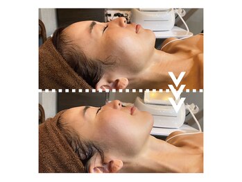 リエイト(Re:eight)/マイクロウェーブリフト1回施術