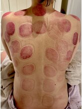 ビレイ(Birei)/カッピング