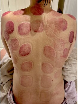 ビレイ(Birei)/カッピング