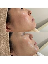 ラ クレール ビューティーサロン(LA CLAIR)/アンストレス(赤みケア)