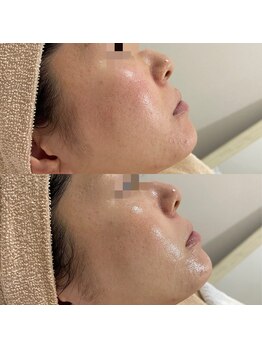 ラ クレール ビューティーサロン(LA CLAIR)/アンストレス(赤みケア)