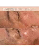 リフィール(Re:feel)/REVIハーブピーリングでシワケア