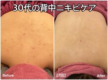 エステティック亜門の雰囲気（皮むけしない背中ピーリング【にきびケア】ピーリング×導入）