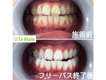 ルブラン 奈良店(Le Blanc)/回数を重ねれば白くなります!