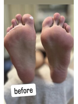 キッキー(Kicky)/ふくらはぎマッサージ＆角質ケア