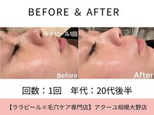 ア クーユ 相模大野店/ララピール/韓国水玉肌/毛穴レス