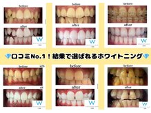 重ねるほどに、驚くほど白く。セルフでも快適に続けられるケア