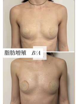 ミセルビューティー 御堂筋本町(micell beauty)/脂肪増殖 バストアップ